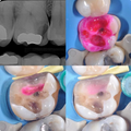 Kuraray Caries Detector - Caries Detector eye