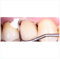 GC Gold Label 1 Luting and Lining Cement Glass Ionomer BIG Pack