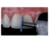 HDM Dental Polishing Discs With Rivets Kit