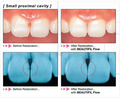 Shofu Beautifil Flow F02 Composite 2g Shade A1, A2, A3, A3.5