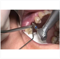 GDC Metal Suction Tube (3.0mm) ASPCT4